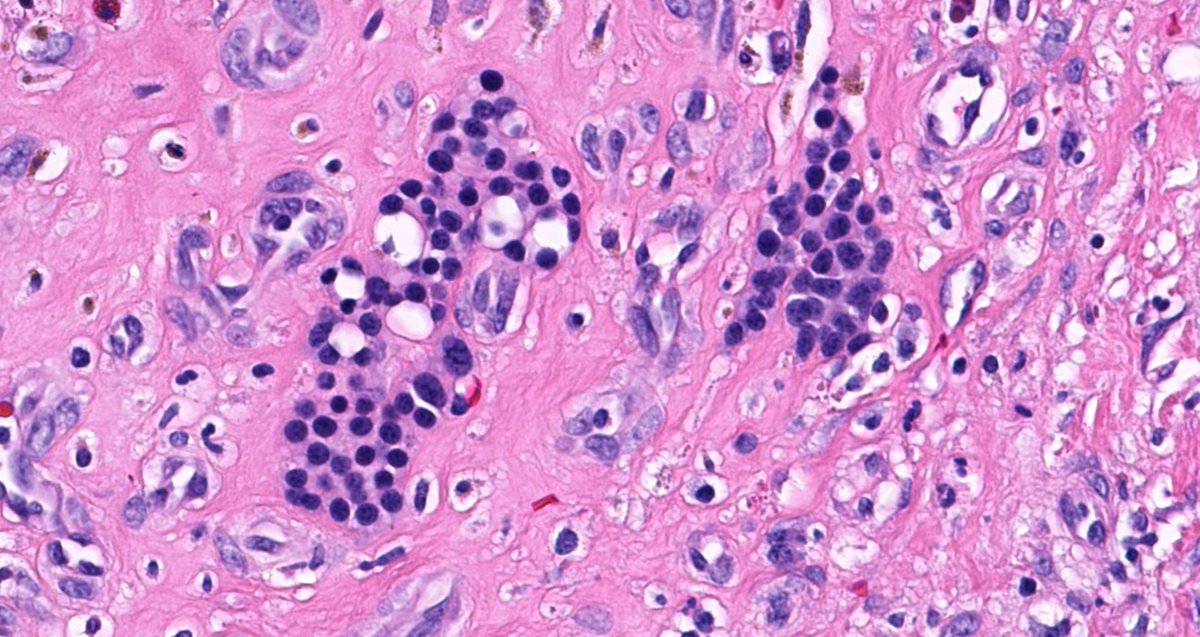 I ❤️ 'bonus' findings in #pathology! What are these incidental round blue cells in a pyogenic granuloma/lobular capillary hemangioma? 
WSI digital slides: kikoxp.com/posts/3746. 
Answer: youtube.com/watch?v=Bep2FP… 
#dermpath #dermatology #dermtwitter #BSTpath #hemepath