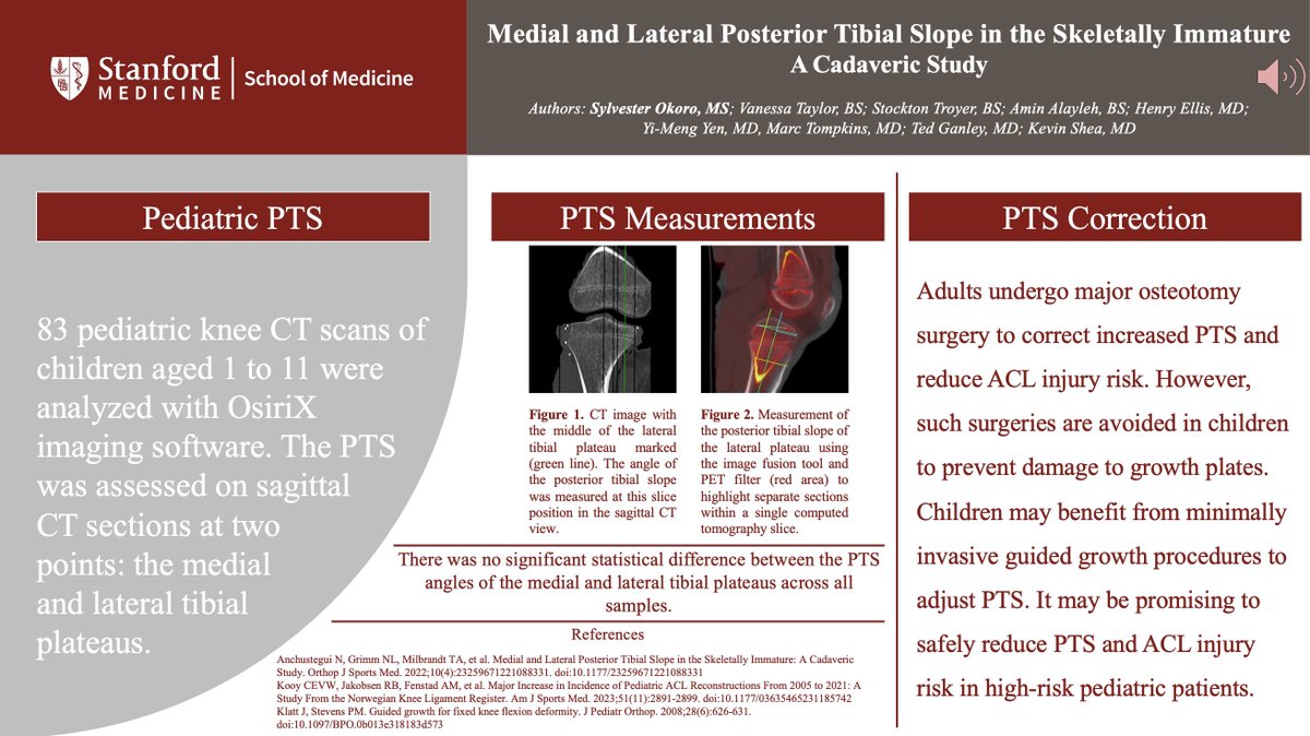 Thrilled to share insights from my recent research on posterior tibial slope and ACL injuries at #MSOS2024. A huge shoutout to Dr. Kevin Shea and our amazing team for their incredible support! Excited for what the future holds in orthopedic research. #orthotwitter