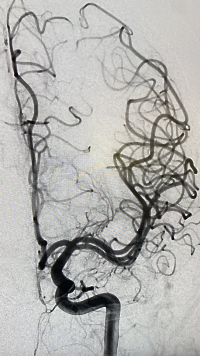 Incidental duplicated left middle cerebral artery, huge implications in intracranial access/stroke. <a href="/EricRSmithMD/">Eric R Smith</a> <a href="/YNIScommittee/">YNIS Committee</a>