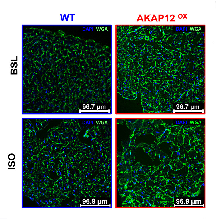 Qasim et al found that #AKAP12 upregulation in cardiac tissue accelerates #cardiac maladaptive remodeling in animal models, & patients with end-stage #HF have upregulation of AKAP12. Learn more at ahajournals.org/doi/10.1161/CI… @brad_mcco2022 @xwehrens