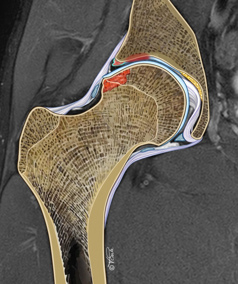 @JOSPT has partnered w/ the Young Athlete's Hip Research (YAHiR) Collaborative to bring you two online events 1) Hip #OA in the athlete & 2) Best practice physiotherapy for the athletic #hip Keen to participate or learn more? click ➡️ ow.ly/UAsU50RhO52 #yourJOSPT