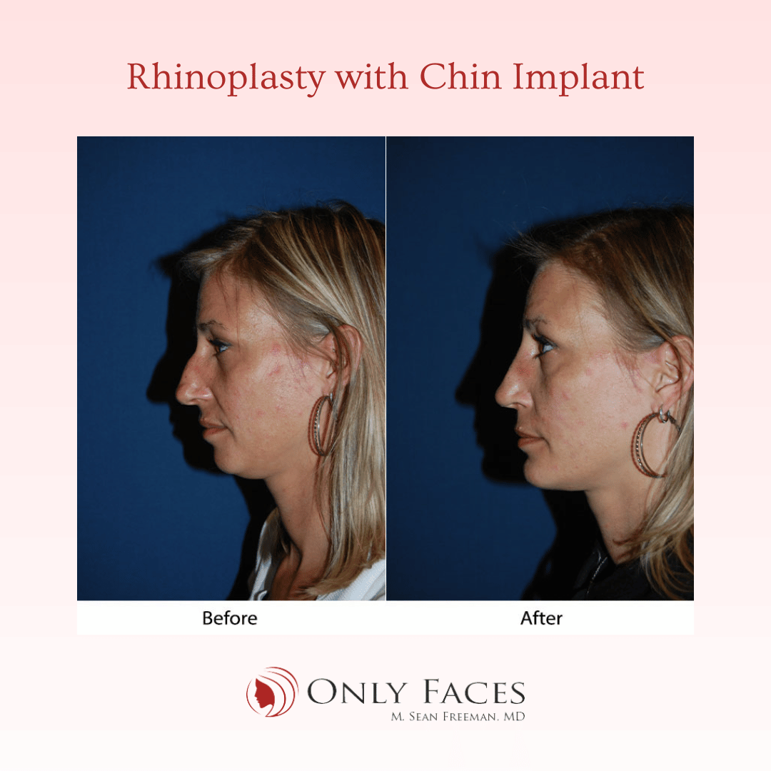 OnlyFacesCLT's tweet photo. This 38-year-old is six months post-op from a #Rhinoplasty with a #ChinImplant. #OnlyFaces https://t.co/tG0iYzirUv