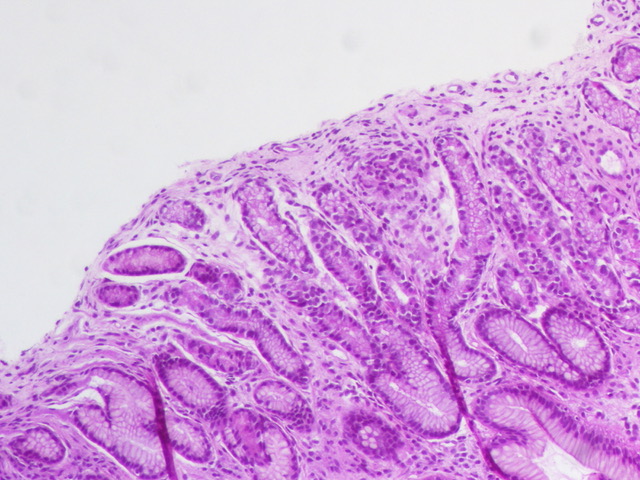 #Pedipath #GIPath #Microgranuloma 
The second case on microgranuloma 
I know it will be polemic 😅
7 years child with abdominal pain 
gastric bx with very mild reactive gastropathy and ....
Who would call it isolated microgranuloma?
Who would ignore it? 
and what clinical