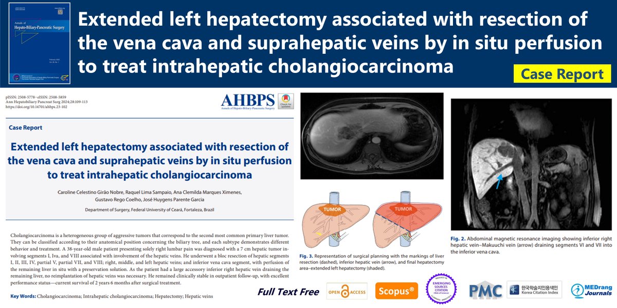 Extended left hepatectomy associated with resection of the vena cava and suprahepatic veins by in situ perfusion to treat intrahepatic cholangiocarcinoma 🌷doi.org/10.14701/ahbps… 2024 Feb;28(1)Caroline Celestino Girão Nobre #Cholangiocarcinoma #Hepatectomy #Hepatic_veins