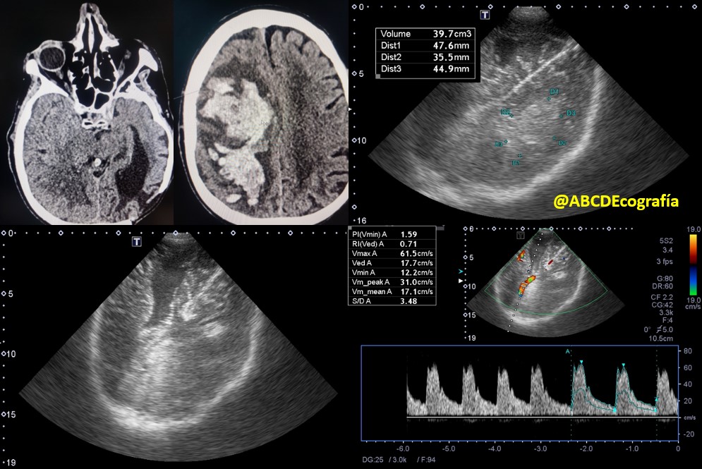 ABCDEcografia's tweet photo. Neuromonitoring
#neuromonitoring, #TCD, #POCUS, #WINFOCUS, #ASARUC https://t.co/z5DIMPMPiK