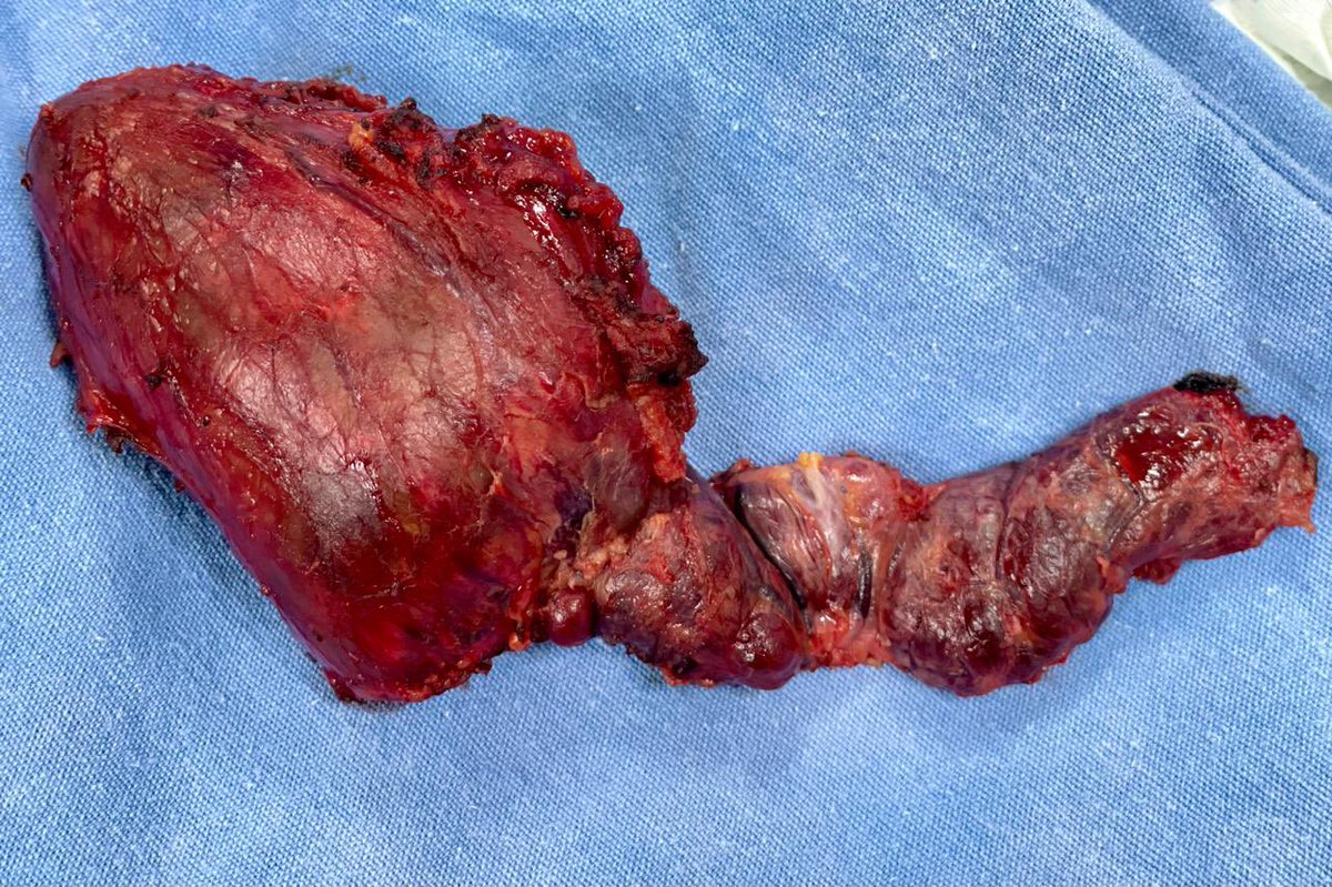 Tiroidectomia total + DRM III + disección compartimento central. #headandneck #surgeon #surgery #Oncology #surgicaloncology