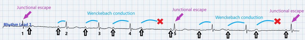 Black arrows = Sinus P waves
Purple arrows = Junctional escape beats triggered by the pauses from non-conducted sinus beats
Blue arcs = PR prolongation
Red cross = P waves failing to conduct due to Wenckebach AV block