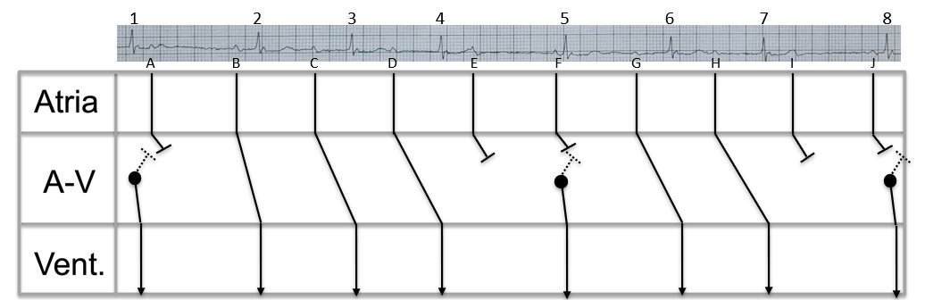 Below are my thoughts on this rhythm:

Underlying Sinus rhythm with 2nd degree AV block Mobitz I (Wenckebach) and junctional escape beats.

To help with my explanation, please see the annotated pictures below