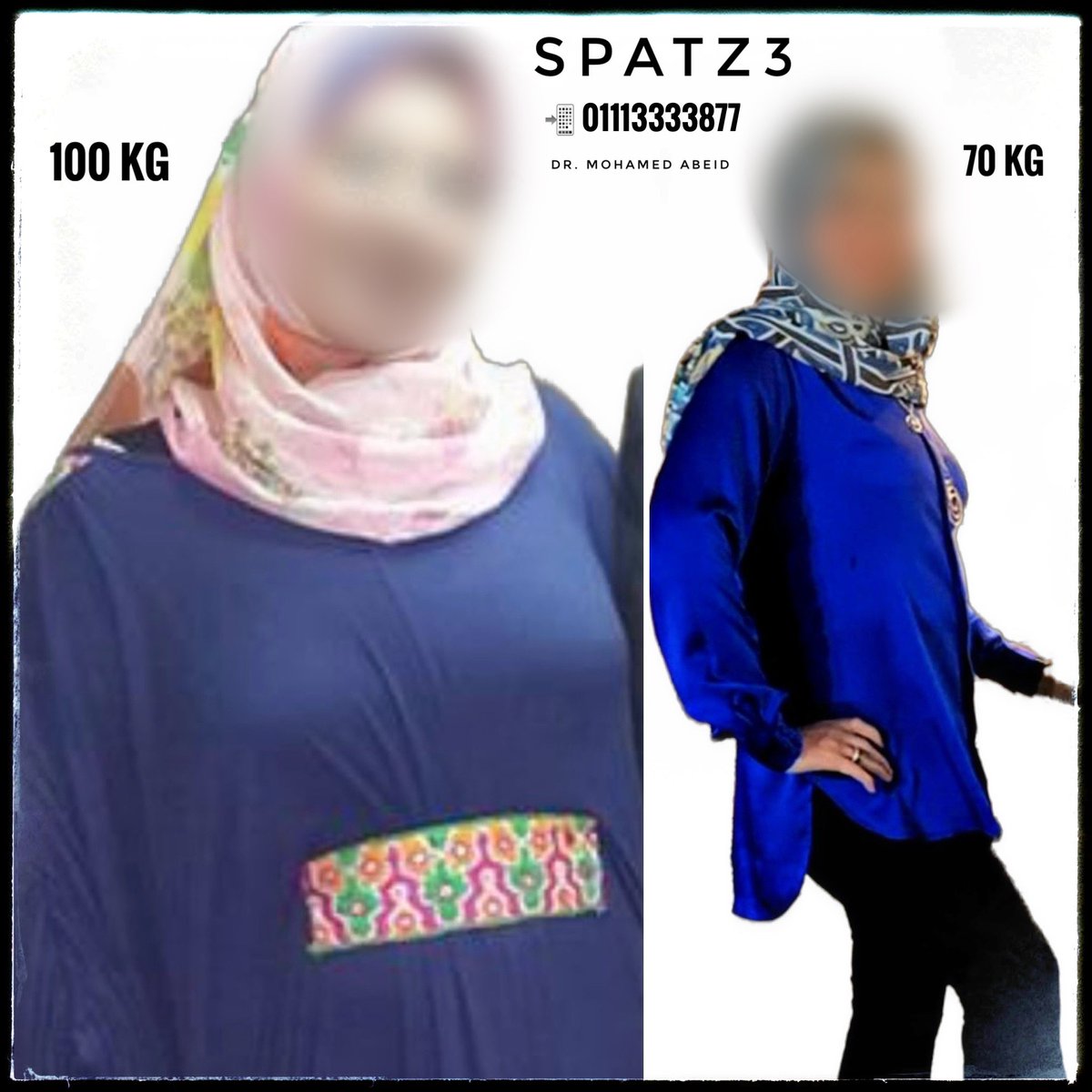 MohamedAbeid's tweet image. 100 % EWL
30 % TWL
Only with #SPATZ3 💪
The best #Weightloss solution in 2024!!