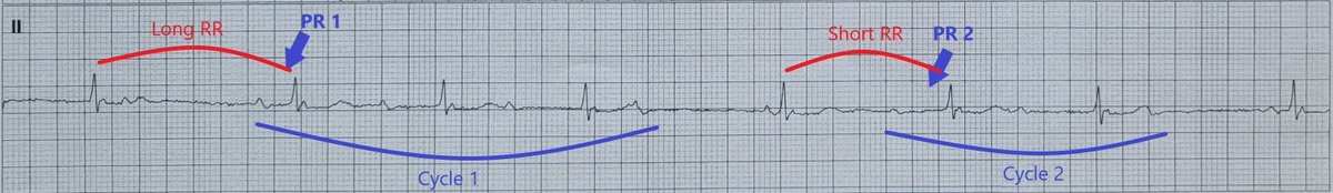 This rhythm may seem a little atypical at first, because the second cycle of Wenckebach conduction starts with a different PR interval to the first cycle (PR 1 is different from PR 2 - see picture below)