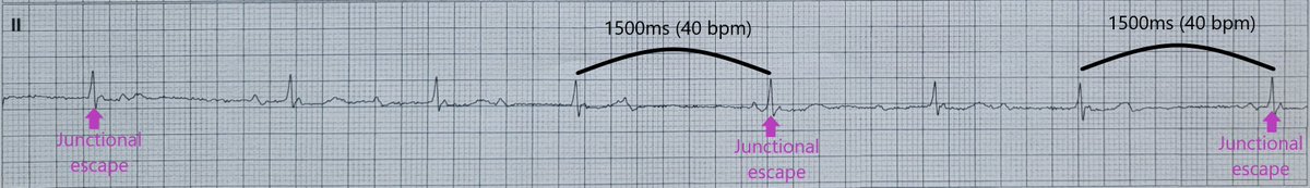 The rhythm or beat will only appear after a specific pause duration - in this case 1500ms/40 bpm. I like to think of it like a safety mechanism to reduce symptoms of syncope.