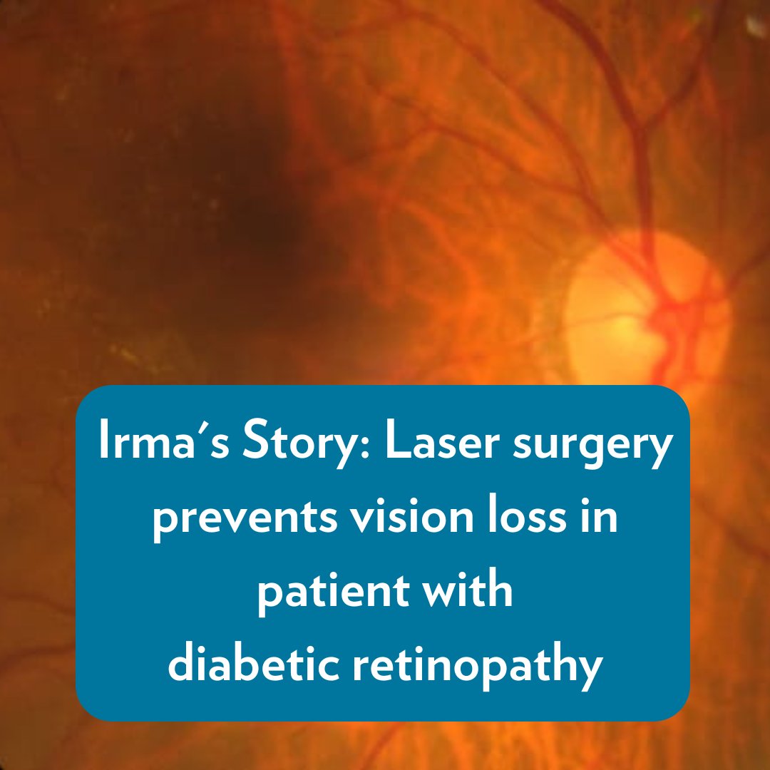 Irma's journey from diagnosis to vision-saving laser surgery is a testament to the importance of regular eye exams, especially for those with #diabetes. Read her story and learn about the vital role of early detection in preserving vision: advance.muschealth.org/library/2024/m… #EyeHealth