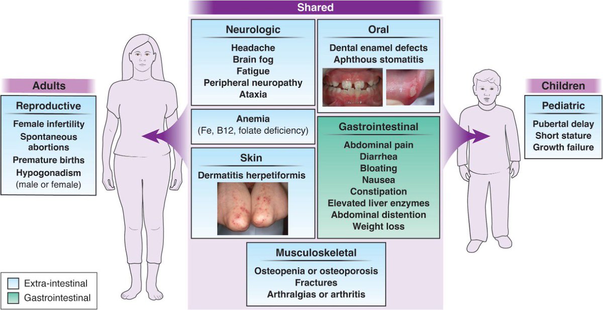 Clinical Presentation & Spectrum of Gluten Symptomatology Celiac Disease. 'Extra-intestinal manifestations & asymptomatic disease, contributes to suboptimal disease detection...' 📄 gastrojournal.org/article/S0016-…