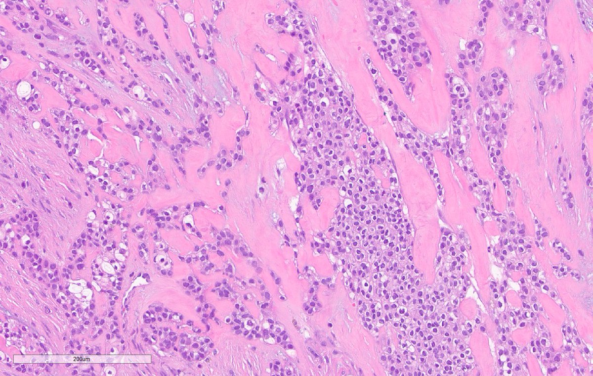 Hyalinizing clear cell carcinoma, salivary glands.

Most in minor salivary glands.
Unencapsulated.

🔬

Cords/trabeculae/nests of bland clear and/or eosinophilic cells in a hyalinized stroma.

Most have EWSR1:ATF1 fusion.

#pathology