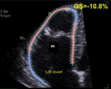 📖 This Sonography journal case report describes the incidental finding of arrhythmogenic right ventricular cardiomyopathy in a late adolescent recreational soccer player using a multimodal diagnostic approach. @WileyHealth