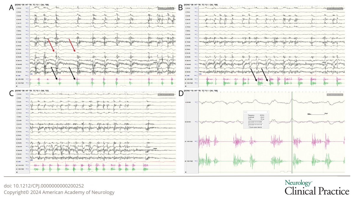 This retrospective review of video-#EEG records for 39 patients reports a detailed analysis of the semiology and neurophysiology of clonic #seizures: bit.ly/3w5VmsQ