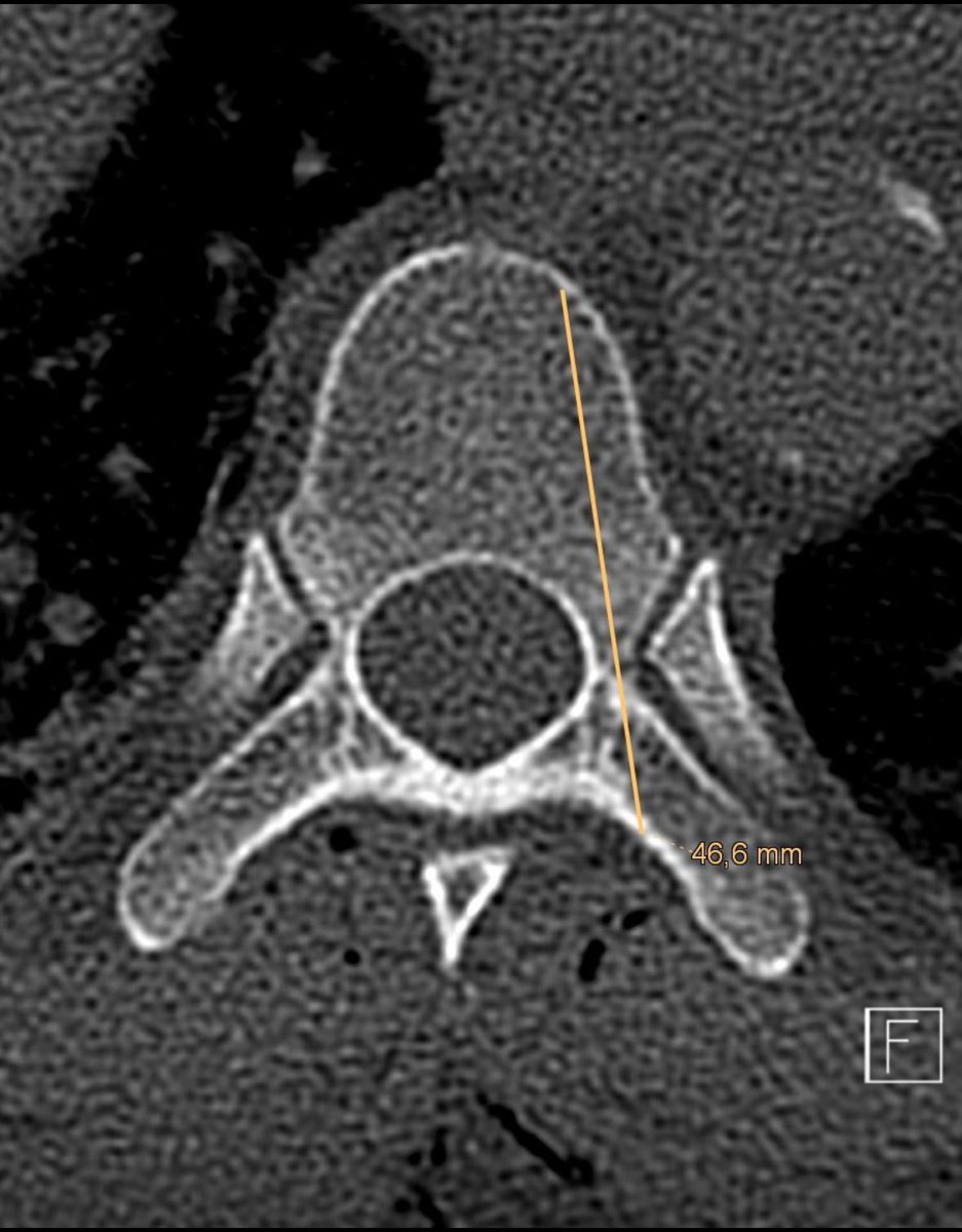 How do you plan your #instrumentation? do you measure your #pedicle #screw length and #plan #surgery the day before or do you just measure intraoperatively? which obviously isn't as easy in #MISS.
#spine #pediclescrew #fixation #instrumentation #howdoyoudoit #algorithm #software