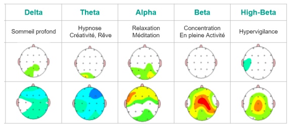 Savez vous ce qu'est un EEG quantitatif ? L’électroencéphalogramme (EEG) permet de mesurer précisément votre activité cérébrale électrique, différente de l’activité chimique, mesurée avec une prise de sang. Un EEG normal est l’observation subjective par le praticien du tracé ...