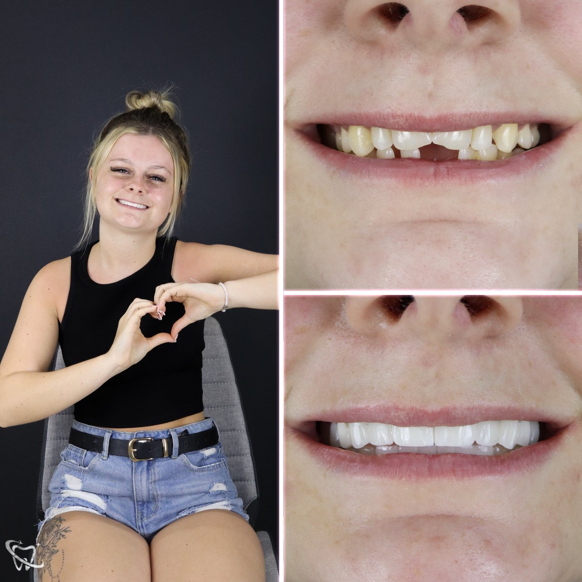 Always shine Olivia! ✨

☎️+90 544 120 40 00
🌐yoursmileturkey.com
📍Antalya/Turkey

#bestdentalclinic #zirconiumcrown #veneer #zirconiumveneer #england #dentalcare #happyface #smilemakeover #smiledesign #beforeandafter #teeth #cosmeticdentistry #emaxveneers #beforeandafter