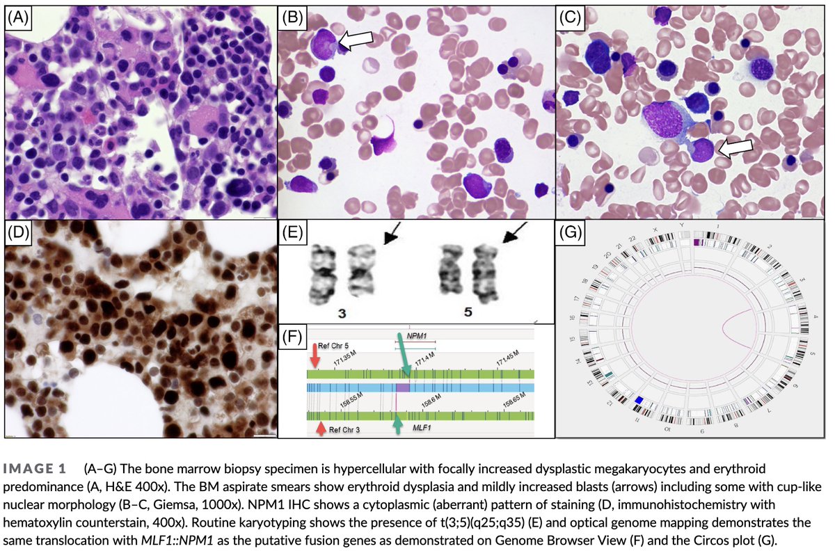 Myeloid neoplasm with <10% blasts and t(3;5)(q25.1;q34)/NPM::MLF1: A classification dilemma Images in #Hematology from Dr. @sanamloghavi and colleagues, now free to access online! onlinelibrary.wiley.com/doi/epdf/10.10…