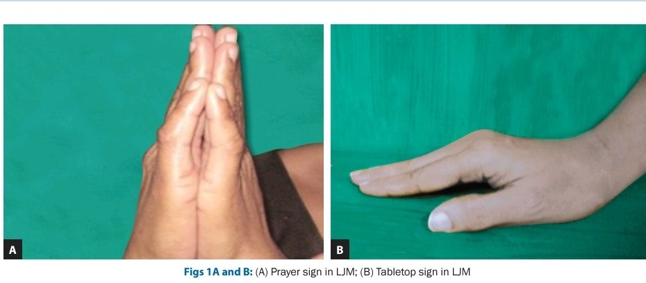 Signs demonstrating limited joint mobility (LJM) of hands.

What is the pathology ❓️

#MedTwitter #MedEd #MedX