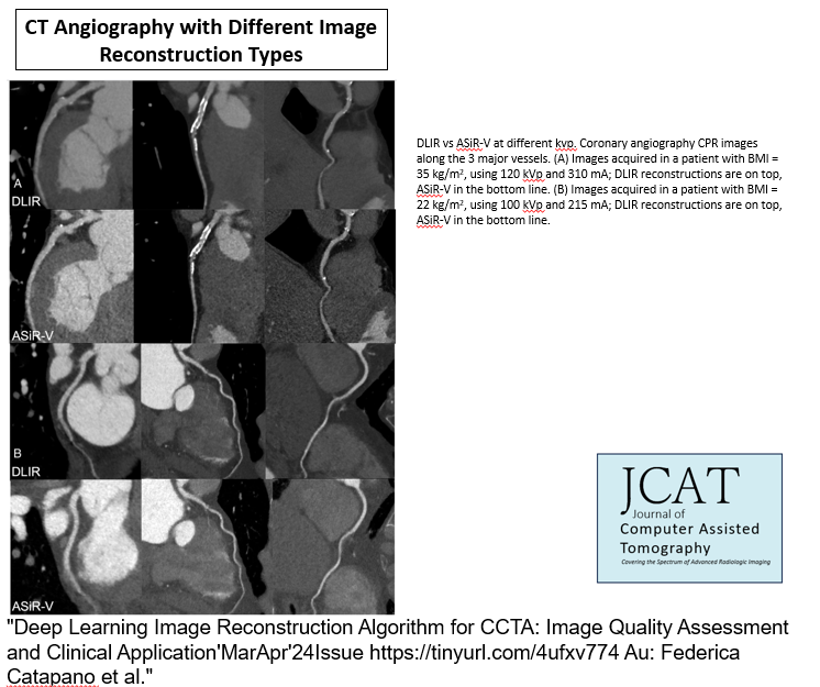 'New @JCATonline
'Deep Learning Image Reconstruction Algorithm for CCTA: Image Quality Assessment and Clinical Application'
MarApr'24Issue tinyurl.com/4ufxv774 Au: Federica Catapano et al. 
#Radiology  #CT  #deeplearning #CTangiography