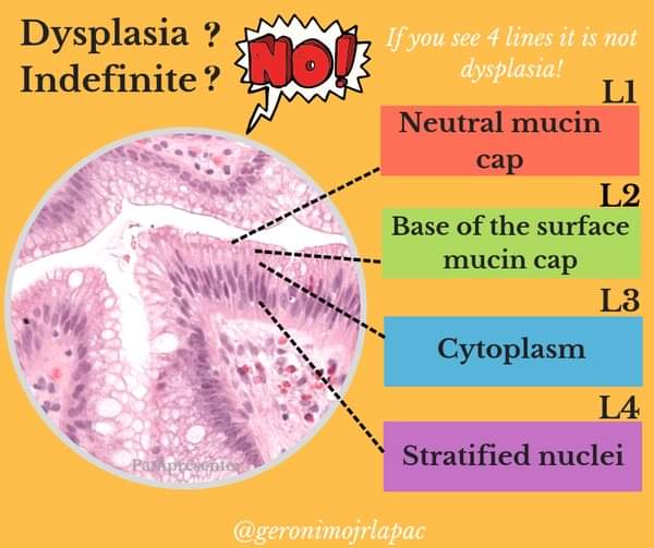 DYSPLASIA IN BARRETT'S ESOPHAGUS ✔️ Did you see 4 lines? If so, it's not dysplasia! #pathplus #pathology #pathologist #gipath