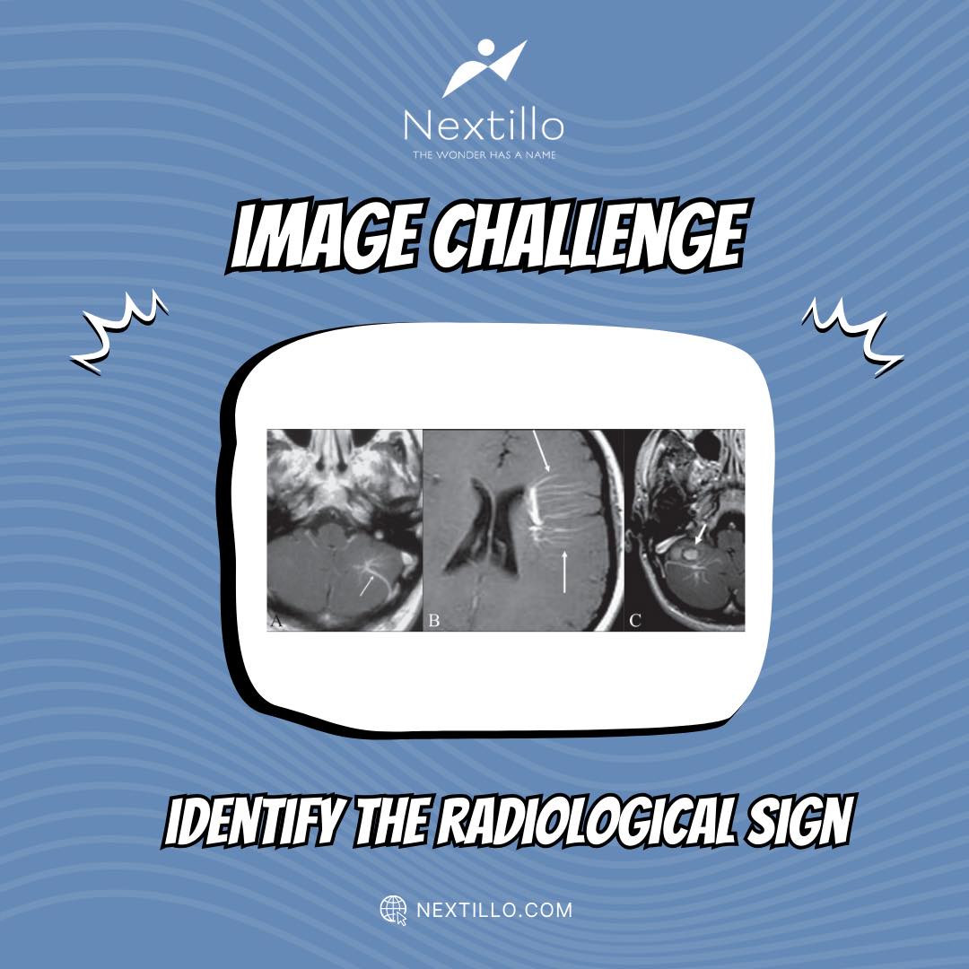 Here’s today’s #ImageChallenge! Can you identify the radiological sign in this image? 📷
#medicalmemes #fmge #fmge_mci_exam #medicalinformation #fmgepreparation #medicalstudent #radiology #radiologysigns #radiologyquiz #mriscan #mriquestions #ctscan #xray #MedTwitter #medx #Mbbs