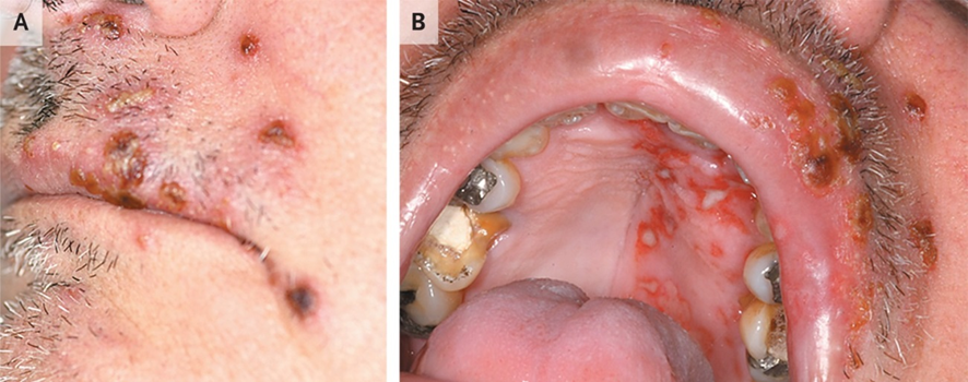 guerreroespejo's tweet image. 59-años,♂️ : vesículas y lesiones costrosas en las regiones perioral (A), úlceras dolorosas en los paladares duro y blando (B), desarrolladas en el transcurso de una semana, dificultad para tragar y hablar
1/3

DOI: 10.1056/NEJMicm1205661
#IDXposts #dermatología 
1/3