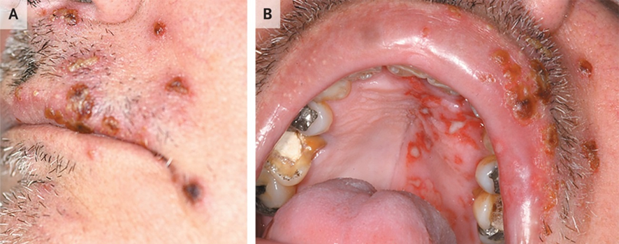 59-años,♂️ : vesículas y lesiones costrosas en las regiones perioral (A), úlceras dolorosas en los paladares duro y blando (B), desarrolladas en el transcurso de una semana, dificultad para tragar y hablar
1/3

DOI: 10.1056/NEJMicm1205661
#IDXposts #dermatología 
1/3