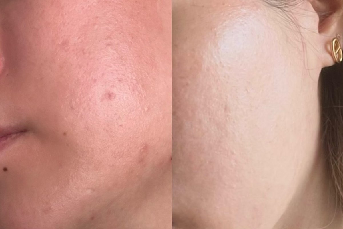 ununfah's tweet photo. เป็นสิวฮอร์โมนซ้ำซาก ใช้ 2 ตัวนี้จาก La Roche-Posay คู่กัน มันเวิร์คแบบเวิร์คมาก หน้าดีขึ้นแบบเห็นได้ชัด สิวค่อยๆสงบ พอเม็ดใหม่ไม่ขึ้น+กดสิวเคลียร์เม็ดเก่าๆออก ทำแบบนี้วนไป สักพักมันรู้สึกเลยว่าผิวค่อยๆดีขึ้นแบบมากๆๆๆ ใช้มาจนจะหมดหลอดแล้ว อยากแนะนำ อยากให้แมสกว่านี้ มันดีจริงๆนะ 🥹