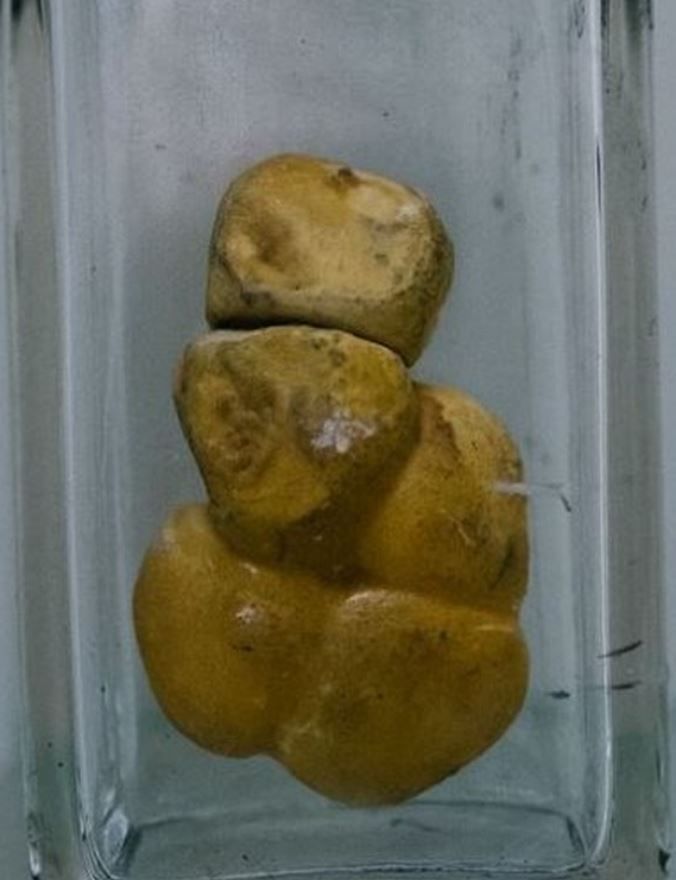 Cholesterol gall-stones from the gall bladder. Four of the gall-stones have fused together and one remains separate. All together they measure 10.5 cm in height, 6 cm in width and 4.5 cm in depth. They were removed by cholecystectomy.