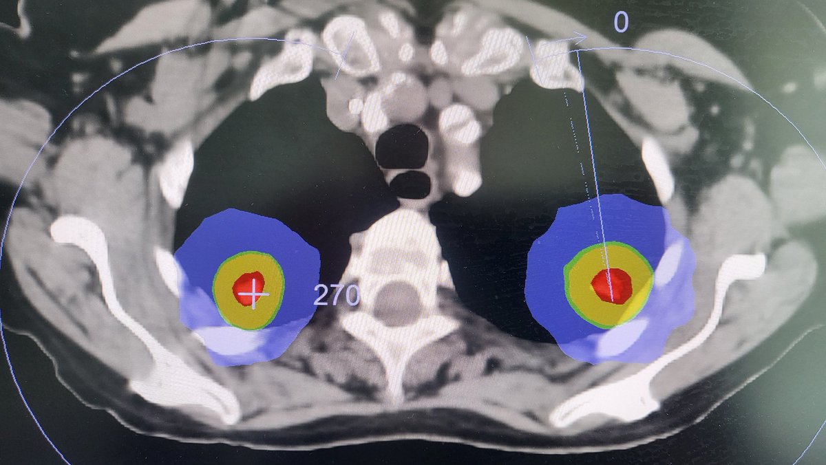 OCathail.SM (@ocathails) on Twitter photo First bilateral synchronous Lung SBRT <a href="/CUH_Cork/">Cork University Hospitals</a> Glandore Radiotherapy Centre today. Highly efficient treatment, in/out 33 mins 💪 World class RT. Great team effort Dr McGibney <a href="/aislingbarryro/">Aisling Barry</a> <a href="/mcgrathe6/">Eoin McGrath</a> <a href="/keatinc/">Claire Keating</a> First bilateral synchronous Lung SBRT <a href="/CUH_Cork/">Cork University Hospitals</a> Glandore Radiotherapy Centre today. Highly efficient treatment, in/out 33 mins 💪 World class RT. Great team effort Dr McGibney <a href="/aislingbarryro/">Aisling Barry</a> <a href="/mcgrathe6/">Eoin McGrath</a> <a href="/keatinc/">Claire Keating</a>