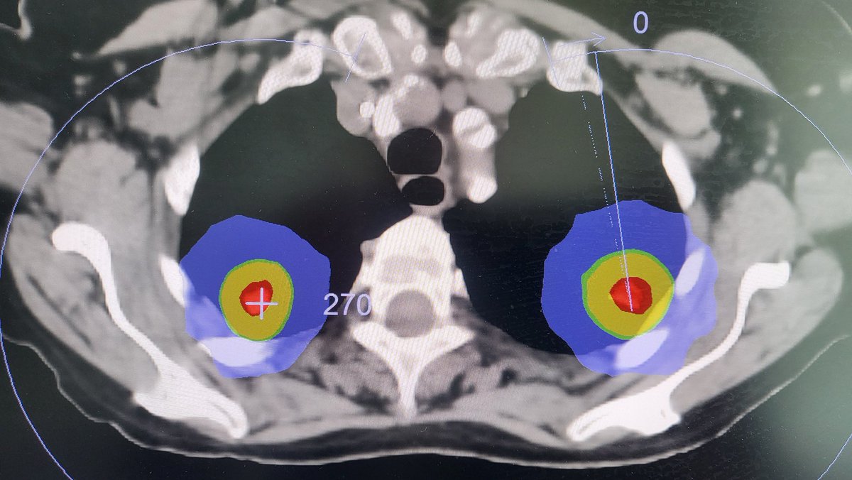 First bilateral synchronous Lung SBRT @CUH_Cork Glandore Radiotherapy Centre today. Highly efficient treatment, in/out 33 mins 💪 World class RT. Great team effort Dr McGibney @aislingbarryro @mcgrathe6 @keatinc