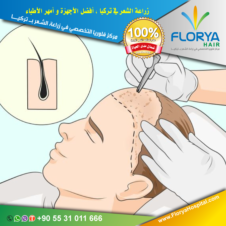 أفضل اطباء تركيا في زراعة الشعر
#زراعة_الشعر_في_تركيا
زراعة الشعر بتقنية DHI , FUE  
أفضل التقنيات المستخدمة
خدمات VIP 
احصل على استشارة مجانية الأن :  ☎️ wa.me/905531011666
FloryaHospital.com