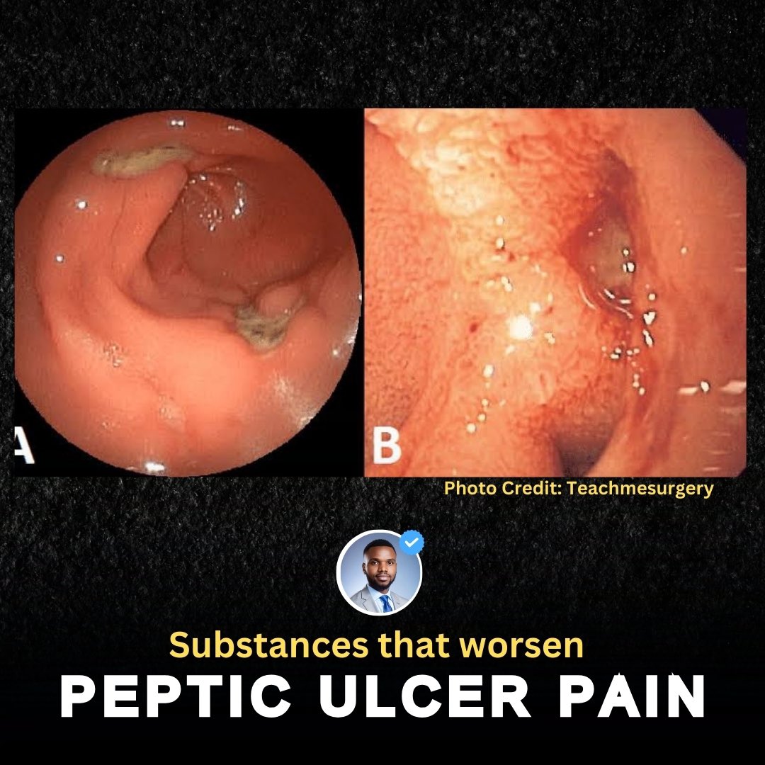 Treatment of peptic ulcers is beyond taking medications alone. Certain substances are considered to be triggers, and could hamper your healing process Let me share some with you 🔃bookmark and share to help someone