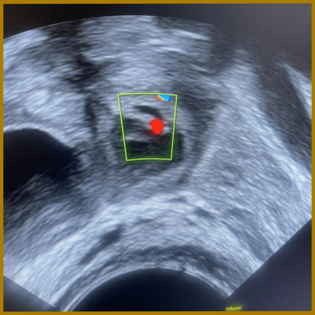 Ultrasound imaging reveals the presence of a right tubal ectopic pregnancy, guiding diagnosis and management.

🌏insightclinicpune.com
📞088558 71212

#InsightClinic #DrSnehal #EctopicPregnancyAwareness #PregnancyComplications #EarlyDetection #MedicalDiagnosis #UltrasoundScan