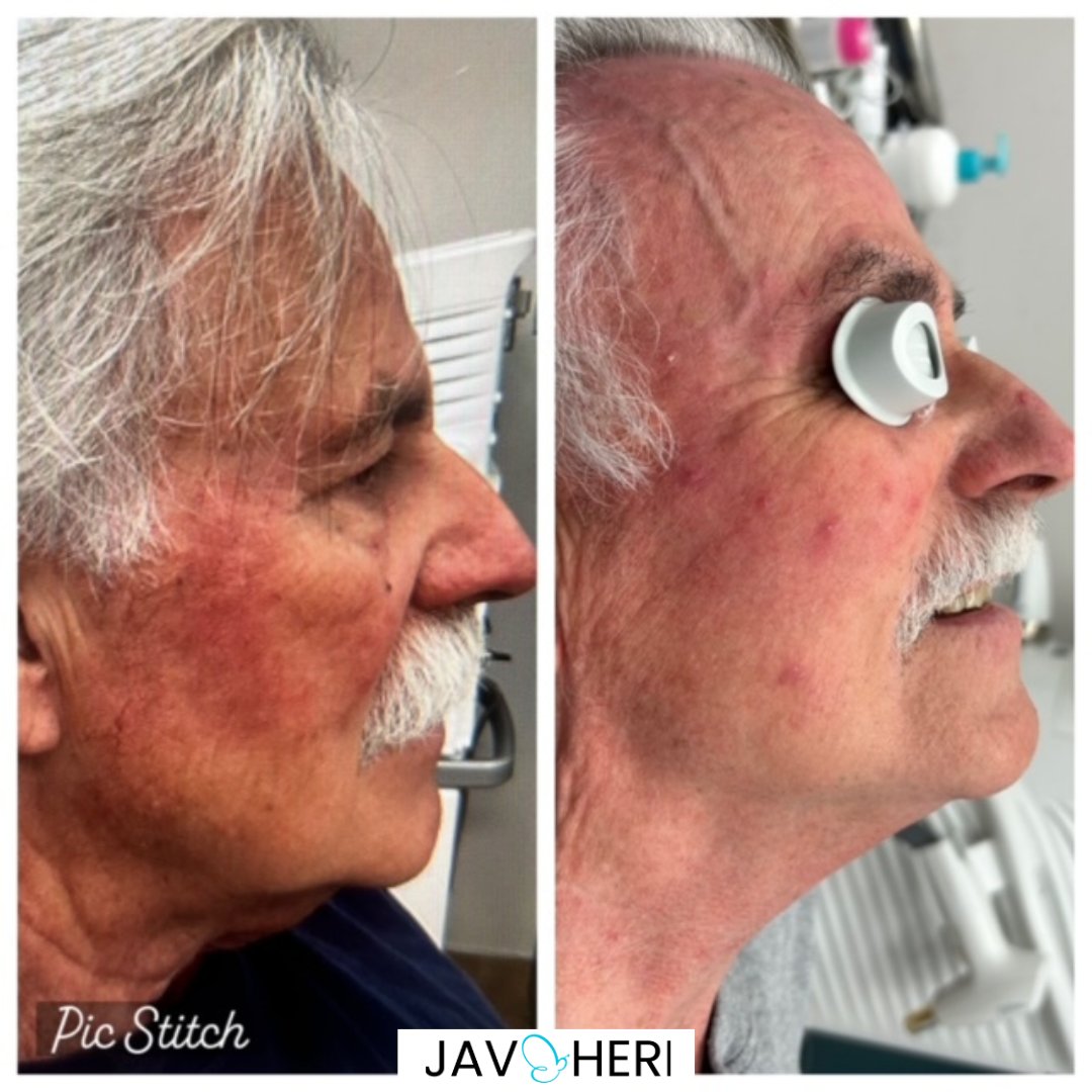 APRIL Is Rosacea Awareness Month

Check out this amazing transformation Our client was struggling with Rosacea & enlarged pores, which were affecting the texture of his skin. But guess what? We've got the perfect solution for him.

#rosaceamonth #rosaceatreatment #skintreatment