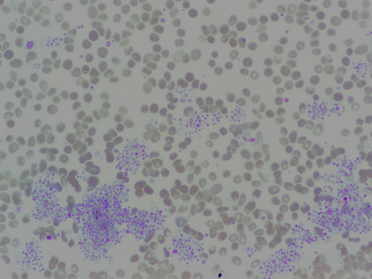 #MorphologyMonday

We see a fair few of these in the lab. What's going on with the platelets and what effect would it have on the count?

#OnlyCells #Platelets #underthescope