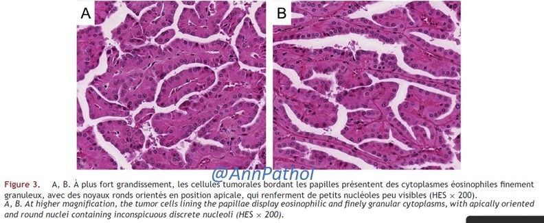 Annpathol's tweet photo. Femme de 57 ans avec une masse rénale de 1,5 cm. Diagnostic ?
57-year-old woman with a 1,5 cm renal tumor. Diagnosis ?
#RenalPath #GUPath #francophonepath https://t.co/0512UlbCLt