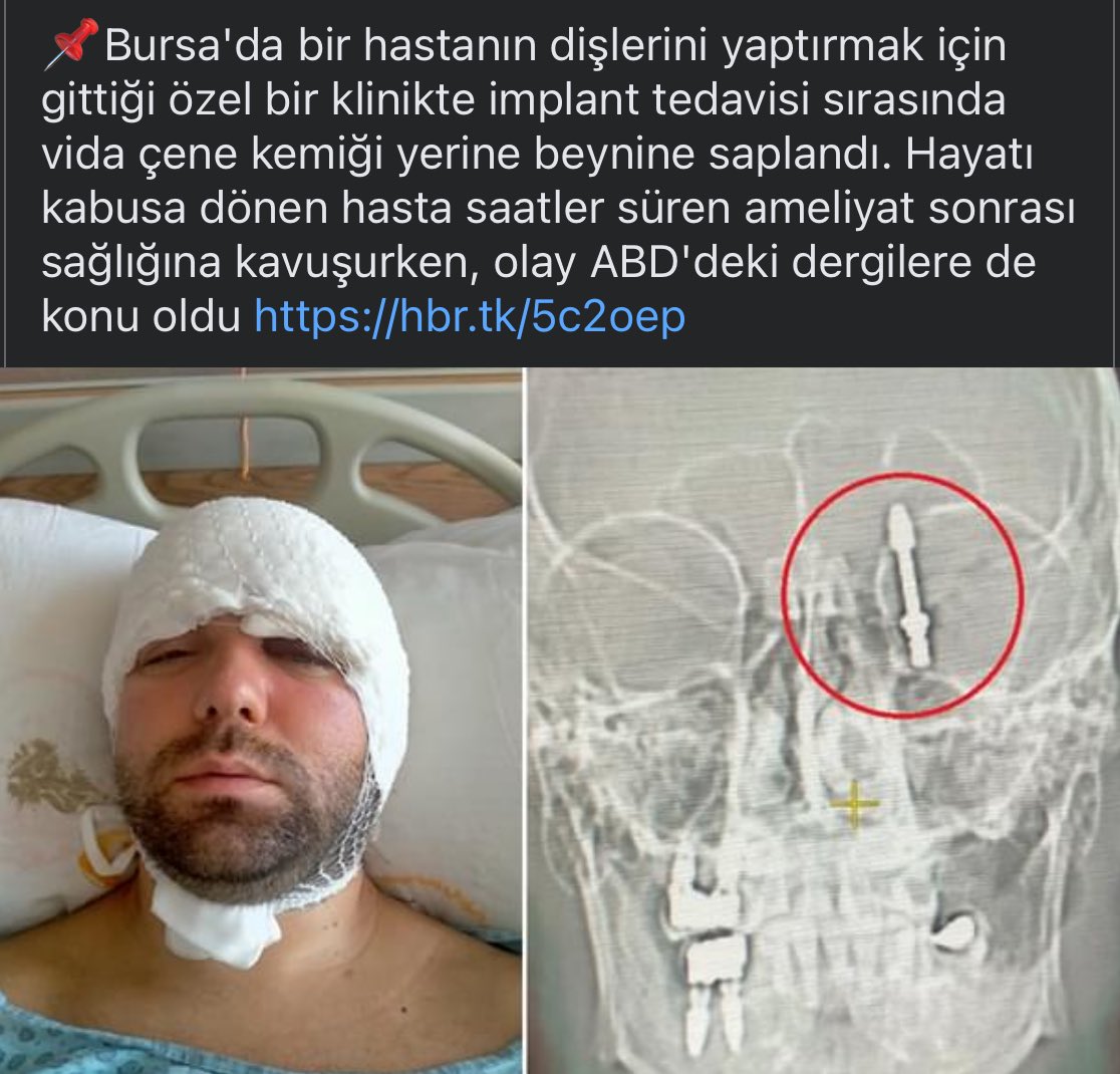 Niyet ettim Allah rızası için diş implantı yapmaya deyip beynine sokmuşlar!… Hani Türkiye sağlık turizminde öncüydü?😎