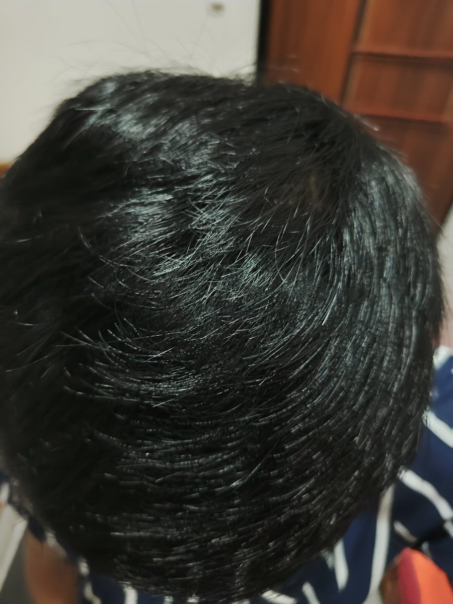 Widino's tweet photo. Karena banyak yg nanya hasilnya, kurang lebih begini lah. Ini gw pakenya jarang-jarang lho, kalo inget aja 😂

Barbershop langganan gw pernah bilang gini "skrg rambutnya lebih tebel n lebat yaa". Trus dalam hati gw bilang "oh ngefek juga ya serum rambut yg itu" wkwkw https://t.co/AbywZBzINy