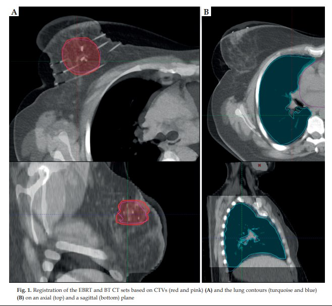 The standard of care in curative treatment of earlystage breast cancer is breast-conserving surgery and post-operative external beam radiotherapy (EBRT) to the whole breast [1,2,3].
termedia.pl/Biological-dos…