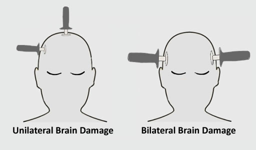 Psychiatrists try to make #ECT aka electroshock sound scientific even though it's not. For example, the terms unilateral and bilateral refer to the placement of #electroshock 'paddles' on the head. But it's not therapy. It's unilateral or bilateral brain damage. #mentalhealth