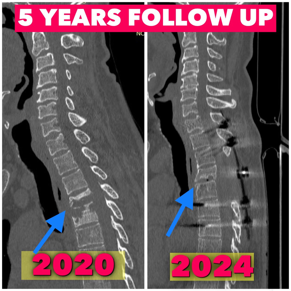 KothiwalaNeal's tweet photo. When we operate the patients, immediately surgeons become hero for patient himself and their families. But the most important thing is to maintain this rapport till long follow up.
#neurosurgeryheals
#pottsspine
#spinesurgery
#spinefixation
#spinefusion
#neurosurgery https://t.co/yfktriz9fV
