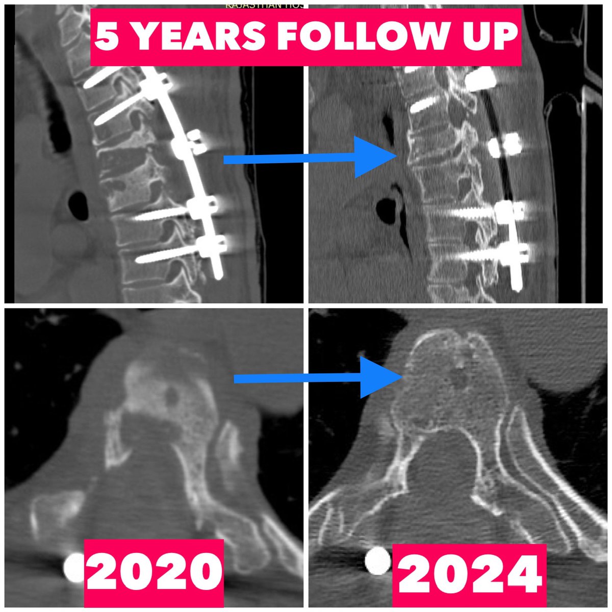 KothiwalaNeal's tweet photo. When we operate the patients, immediately surgeons become hero for patient himself and their families. But the most important thing is to maintain this rapport till long follow up.
#neurosurgeryheals
#pottsspine
#spinesurgery
#spinefixation
#spinefusion
#neurosurgery https://t.co/yfktriz9fV