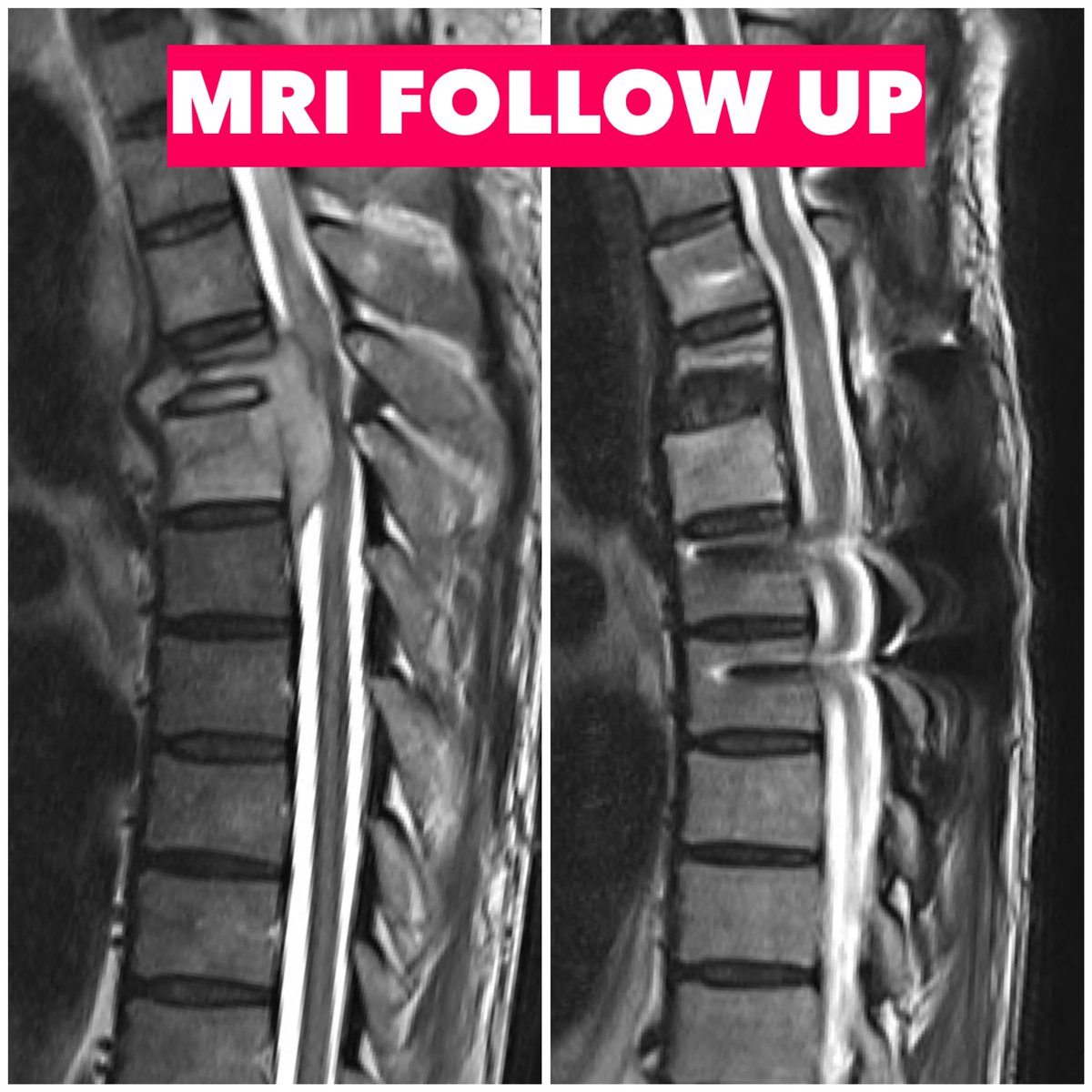 KothiwalaNeal's tweet photo. When we operate the patients, immediately surgeons become hero for patient himself and their families. But the most important thing is to maintain this rapport till long follow up.
#neurosurgeryheals
#pottsspine
#spinesurgery
#spinefixation
#spinefusion
#neurosurgery https://t.co/yfktriz9fV
