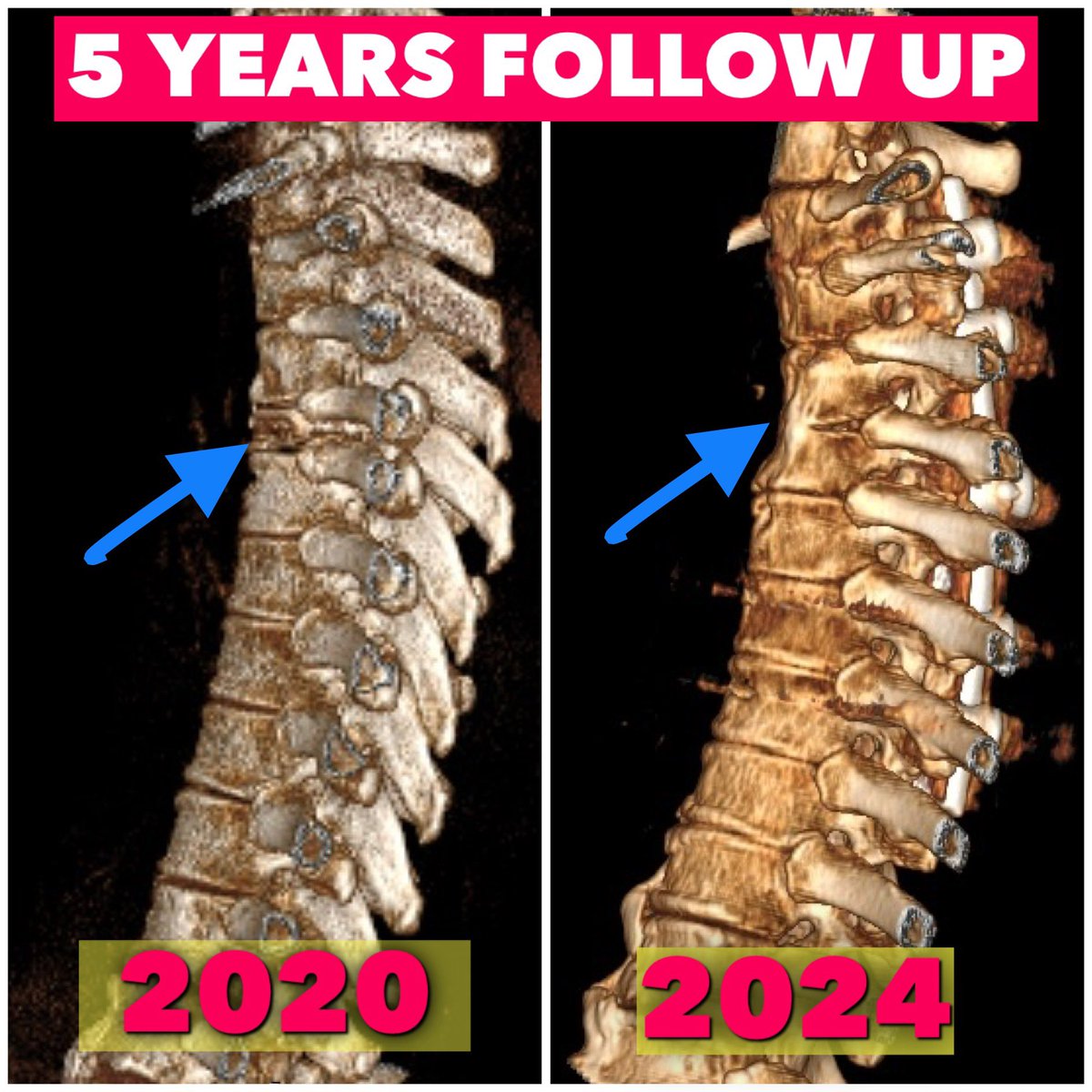 KothiwalaNeal's tweet photo. When we operate the patients, immediately surgeons become hero for patient himself and their families. But the most important thing is to maintain this rapport till long follow up.
#neurosurgeryheals
#pottsspine
#spinesurgery
#spinefixation
#spinefusion
#neurosurgery https://t.co/yfktriz9fV