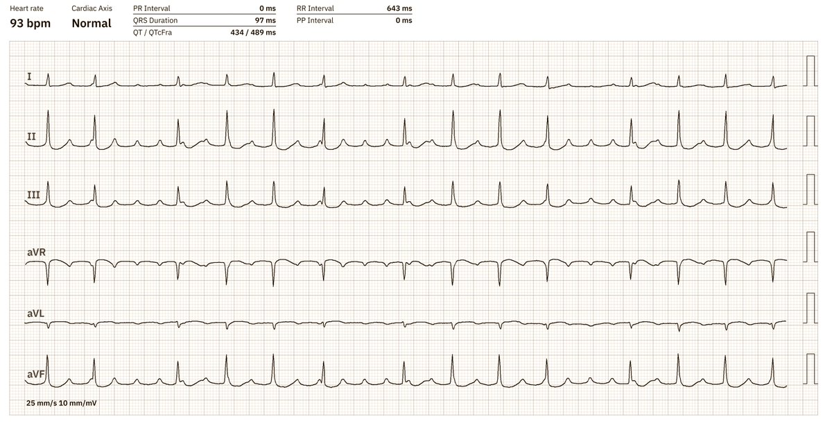What is special about this ECG with AFL?