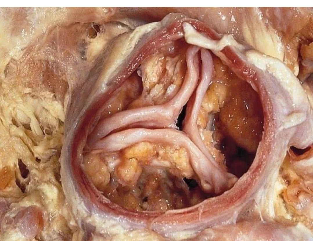 Diagnose the lesion of the aortic valve.
Hint: A 60-year-old man has high serum calcium levels.
#MedTwitter #MedEd #MedX